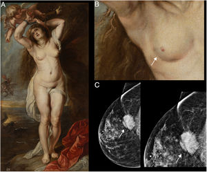 A) Andrómeda encadenada, de Peter Paul Rubens (1634), pintura sobre tela exhibida en la Biblioteca Museo Víctor Balaguer. B) Detalle de la mama derecha representada en el óleo, en donde se observa en el cuadrante inferoexterno una retracción de la piel (señalizado con una flecha blanca). C) Mamografía. Incidencia craneocaudal, patrón glandular ACR B en el sector externo, plano posterior, donde se visualiza una imagen nodular densa irregular espiculada que retrae el músculo pectoral y la piel (señalizado con una flecha blanca) y ampliación magnificada de la imagen nodular señalizada con una flecha blanca.