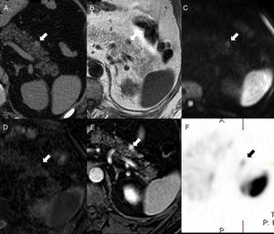 Varón de 52 años con antecedentes de artritis gotosa. La tomografía computarizada sin contraste (A) muestra un pequeño nódulo (ﬂecha) en la cara anterior de la cola del páncreas, hiperdenso en comparación con el parénquima pancreático e isodenso con el bazo. En la resonancia magnética, el nódulo es isointenso al bazo en T1 (B), difusión (b1000, C) y mapa ADC (D). T1-THRIVE posgadolinio en fase de equilibrio (E) que exhibe la pequeña lesión de la cola pancreática con mayor realce que el bazo. In-111-pentreotide (Octreoscan) (F) muestra una captación focal débil en el lugar de la lesión, lo que la hace compatible con tumor neuroendocrino.