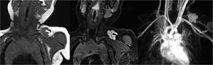 Lactante de 1 mes de vida con un hemangioma infantil proliferativo en la región supraclavicular izquierda. La RM coronal potenciada en T1 (a) revela una masa hipointensa lobulada. La masa es hiperintensa en la imagen STIR (b). También se observan vacíos de señal dentro de la lesión que reflejan vasos de flujo rápido (flechas) (a, b). No se identifica edema perilesional. La imagen de angio-RM en 3D en fase arterial (c) revela el característico realce precoz de la lesión sin derivación arteriovenosa.