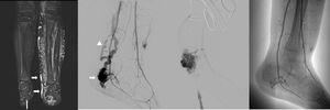 Varón de 9 años con síndrome de Parkes-Weber. La imagen RM coronal en STIR (a) revela una marcada hipertrofia de la extremidad izquierda, hiperintensidad subcutánea difusa y drenaje venoso dilatado (flechas) por múltiples malformaciones arteriovenosas (MAVs). La arteriografía de la extremidad inferior izquierda (b) muestra una gran MAV que cubre el maléolo medial del tobillo izquierdo (flecha), con drenaje venoso precoz (punta de flecha). Punción directa del componente venoso de la MAV del tobillo izquierdo (c), esclerosis con alcohol y disminución del flujo (d).