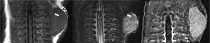 Recién nacido de 1 día de vida con un hemangioma congénito en el área escapular izquierda. En la RM se observa una masa de partes blandos bien definida, hipointensa en las imágenes coronales potenciadas en T1 (a) e hiperintensa en la imagen STIR (b). En estas imágenes (a, b) también se observan vacíos de señal dentro de la lesión, que corresponden a vasos de flujo rápido (flechas). No se identifica edema perilesional. La imagen de angio-RM con contraste en fase arterial (a) revela el característico realce precoz de la lesión.