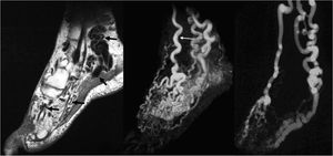 Mujer de 35 años con una malformación arteriovenosa (MAV) en el pie izquierdo. En las imágenes FSE (fast spin-echo) se aprecian arterias nutricias de alto flujo agrandadas, venas de drenaje, el nido de la MAV y vacíos de señal (a) (flechas). La angio-RM en fase arterial (b) muestra el aporte arterial de la MAV, principalmente a través de una arteria dorsal del pie tortuosa y dilatada (flecha fina), así como un llenado precoz del nido (asterisco), y las venas de drenaje (puntas de flecha). Excelente correlación con la angiografía (c).