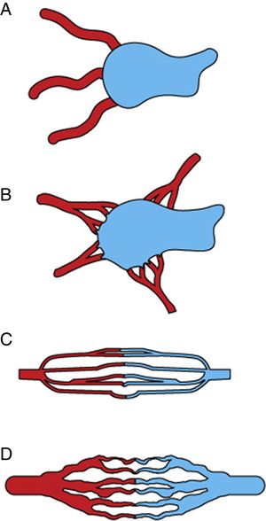 Representación esquemática de la clasificación angiográfica de las malformaciones arteriovenosas en cuatro tipos, adaptada de Cho et al.28. A) Tipo I (fístulas arteriovenosas), comunicación de no más de tres arterias a una única vena de drenaje; B) tipo II (fístulas arteriovenosas), comunicación de múltiples arteriolas a una única vena de drenaje; C) tipo III (fístula arteriovenosa con fistula no dilatada), múltiples comunicaciones finas entre arteriolas y vénulas; D) tipo IIIb (fistula arteriovenosa con fistula dilatada), múltiples comunicaciones entre arteriolas y vénulas que, en la angiografía, se muestran como una compleja red vascular.