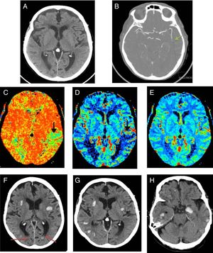 A-E) Estudios pretratamiento. Tomografía computarizada (TC) de cerebro sin contraste intravenoso (A), angio-TC-polígono de Willis (B) y estudio de perfusión cerebral (C-E) realizados a la paciente ante la sospecha de ictus isquémico. A) En la TC basal no se observan signos de isquemia aguda (ASPECTS 10). B) En la angio-TC-polígono de Willis se identifica un stop en segmento M2 izquierdo sugestivo de la presencia de trombo. C) Aumento del tiempo de tránsito medio (flecha) visible en los mapas de perfusión. D) disminución del flujo sanguíneo (flecha). E) volumen normal, sin variación en el estudio de perfusión. Las alteraciones mencionadas se localizan en la región parietal izquierda, territorio de la arteria cerebral media izquierda, y son sugestivas de penumbra. F-H) TC cerebral sin contraste, cortes axiales, realizada 24 horas tras el inicio del tratamiento fibrinolítico. Se identifican múltiples focos de sangrado, bilaterales, alejados del área de isquemia, de distribución difusa cortical, lobar y de predominio supratentorial. Núcleos grises profundos respetados. La semiología radiológica de los hallazgos descritos es sugestiva de angiopatía amiloide. Niveles hemáticos en astas ventriculares occipitales izquierdas (flechas en panel F).