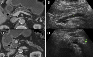 Hallazgos clásicos de pancreatitis crónica en tomografía computarizada (TC) y ecografía. Se observa atrofia glandular, dilatación del conducto pancreático principal y calcificaciones en TC (A y C). B) La dilatación del conducto pancreático (*) y las calcificaciones (flecha en D) también pueden identificarse en ecografía.