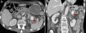 Complicaciones de la pancreatitis crónica: seudoaneurisma en el interior de un seudoquiste pancreático (flechas). Imágenes de tomografía computarizada abdominal en planos transversal (A) y coronal (B) con contraste intravenoso, en fase portal. Obsérvese seudoaneurisma en el interior del seudoquiste (flecha).
