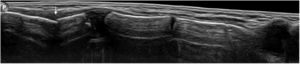 Ultrasonografía, corte sagital, que muestra disrupción de cortical (flecha blanca) por fractura en el manubrio esternal.