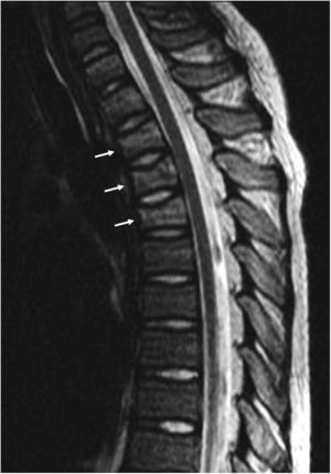 Resonancia magnética sagital TSE T2 de columna torácica, con alteración de intensidad en cuerpos vertebrales T2-T4 por fracturas flexocompresivas (flechas blancas), asociadas a fractura esternal.
