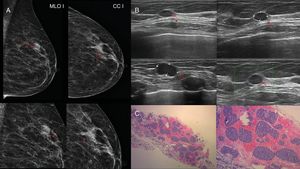 Caso 5. Mujer de 74 años diagnosticada hace 1 año de tumor neuroendocrino de intestino. A) Mamografía de mama izquierda con incidencias mediolateral oblicua y craneocaudal e incidencias magnificadas en el cuadrante superoexterno (CSE) donde se observa un nódulo oval denso de márgenes microlobulados (flecha roja). B) Ecografía de mama izquierda de CSE donde se observa un nódulo oval hipoecogénico, sólido, de márgenes microlobulados, con Doppler positivo (flecha roja). C) Anatomía patológica (hematoxilina-eosina 2,5x y10x): tumor neuroendocrino con patrón glandular en “nidos” y con hipercromatismo nuclear; presenta típicos núcleos redondos u ovales con nucléolos irregulares punteados. Inmunohistoquímica: cromogranina positiva.