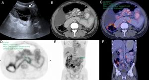 Varón de 49 años, en estudio por dolor abdominal, con antecedente de enfermedad renal crónica en estadio V, en diálisis peritoneal desde hace 5 años. A) Ecografía abdominal en modo B, corte transversal del flanco izquierdo donde se evidencia una colección líquida loculada (flecha). B a F) Tomografía por emisión e positrones-tomografía computarizada, cortes transversal (B, C y D) y coronal (E y F) que muestran aumento de la captación del radiotrazador (18F-FDG) de manera difusa en las paredes del intestino delgado. SUV máximo: 5,71.