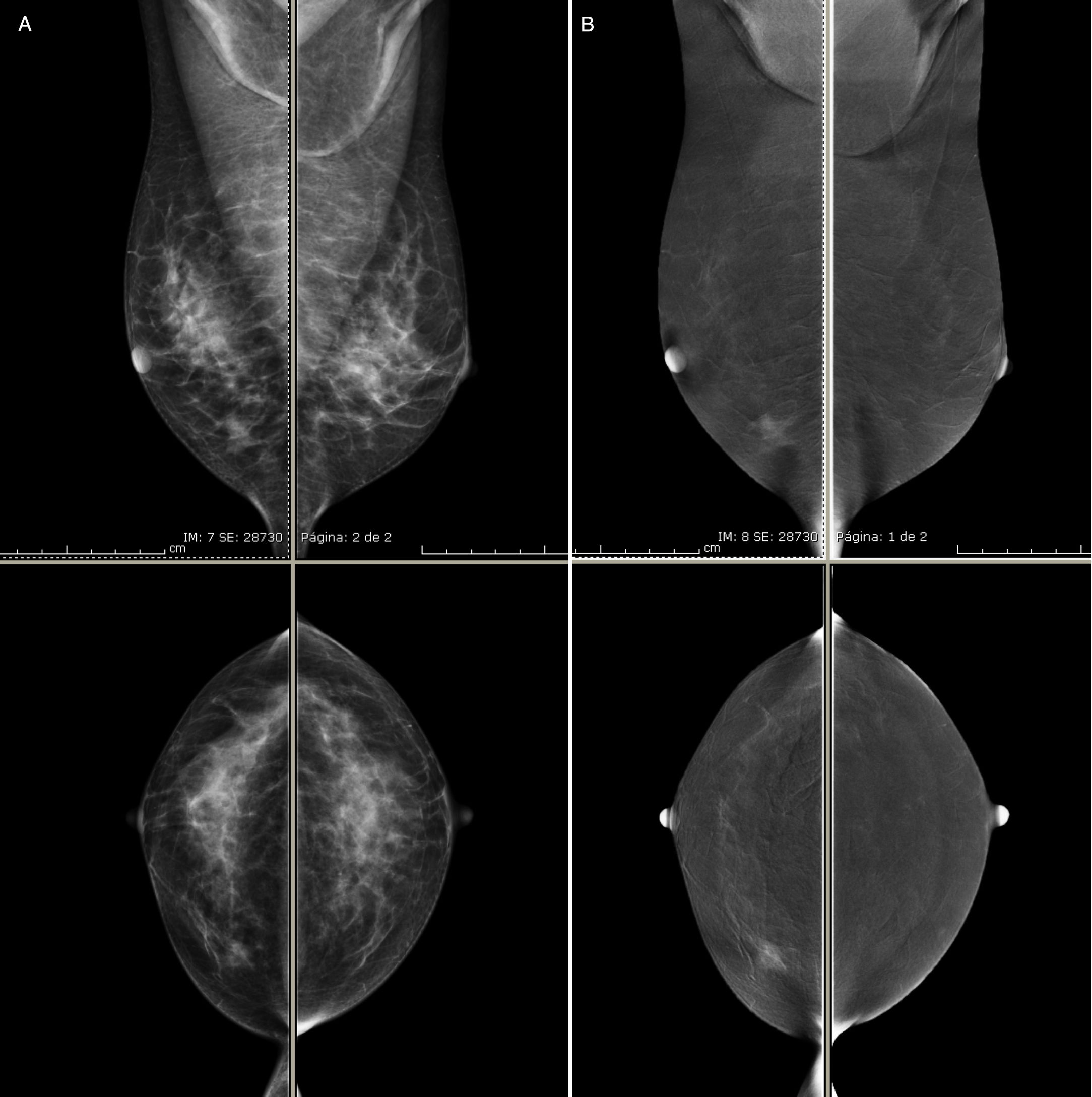 Evaluación de la aplicabilidad del léxico BI-RADS® de la resonancia ...