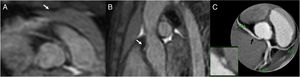 Niña de 7 años con dolor torácico. En las reconstrucciones multiplanares axiales (A) y sagitales (B) secuencia WH3D se observa el origen anómalo de la coronaria derecha desde el seno coronario izquierdo (flechas), que se confirma mediante TC coronaria (C). La morfología fusiforme o en “lenteja” sugiere la presencia de estenosis significativa.