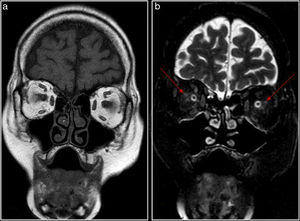 Resonancia magnética orbitaria en secuencias coronal T1 (A) y coronal T2 (B) con saturación de grasa. Se aprecia mínima alteración de la señal de la grasa intraconal, adyacente al nervio óptico (flechas).