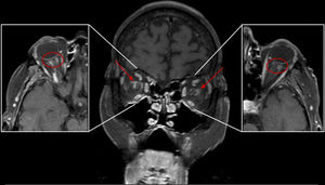 Secuencias T1 con saturación de grasa posgadolinio en coronal y axial, en las que se aprecia un realce de la grasa intraconal perineural y realce discontinuo de la vaina de los nervios ópticos (Cor: flechas; axial: círculo).