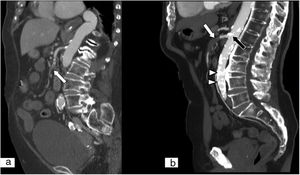 Isquemia mesentérica de origen arterial. A) Embolia de la arteria mesentérica superior. Reconstrucción MPR en plano sagital de tomografía computarizada (TC) abdominopélvica con contraste intravenoso yodado en fase arterial que muestra un émbolo en el interior de la arteria mesentérica superior (flecha blanca), que se localiza distal al origen de la arteria. B) Trombosis de la arteria mesentérica superior. Reconstrucción MPR en plano sagital de TC abdominopélvica con contraste intravenoso yodado en fase arterial, que muestra la existencia de un trombo en el tronco principal de la arteria mesentérica superior (flecha blanca) que implica a los 2-3 primeros centímetros del origen de la arteria. Además, se aprecia una mayor carga ateromatosa que en el cuadro embólico y se objetivan llamativas calcificaciones por cambios ateroescleróticos en los orígenes de la arteria mesentérica superior (flecha negra) y en la arteria aorta abdominal (puntas de flecha blancas).