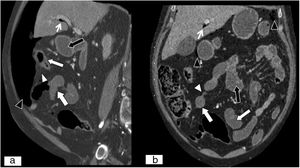 Perforación intestinal isquémica. Reconstrucción MPR en plano sagital (A) y reconstrucción MPR en plano coronal (B), de tomografía computarizada abdominopélvica con contraste intravenoso yodado en fase portal. Asas de intestino delgado con abundante contenido líquido en su interior en relación con íleo paralítico (flechas negras). Asas de intestino delgado con escaso realce parietal (flechas blancas) y fina lámina de líquido libre adyacente (puntas de flecha blancas). Neumoperitoneo (puntas de flecha negras) y gas periportal (flechas blancas finas).