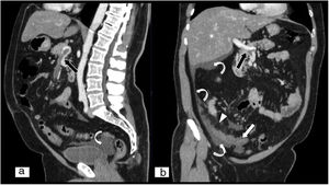 Isquemia mesentérica de origen venoso. A) Reconstrucción MPR en plano sagital de tomografía computarizada (TC) abdominopélvica. B) Reconstrucción MPR en plano coronal oblicuo de TC abdominopélvica, ambas con contraste intravenoso yodado en fase portal. Defecto de repleción en la vena mesentérica superior que se extiende hacia el extremo proximal de la vena porta (flechas negras). Se aprecian asas de intestino delgado con disminución del realce parietal (flecha blanca), ingurgitación de vasos mesentéricos y aumento de la densidad o estriación de la grasa por edema (punta de flecha blanca). También se objetiva líquido libre en gotiera paracólica derecha, espacio perihepático y en pelvis (flecha blanca curva).