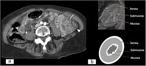 Edema de la pared intestinal por trombosis venosa. A) Tomografía computarizada abdominopélvica, plano axial, con contraste intravenoso yodado en fase arterial tardía/portal precoz. Engrosamiento concéntrico de la pared intestinal a expensas de la submucosa por edema de esta. Hiperrealce de la mucosa y la serosa con hipodensidad de la submucosa (signo de la diana) (flecha blanca) y líquido libre asociado (punta de flecha blanca). B) Imagen esquemática del signo de la diana.