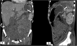 Isquemia mesentérica no oclusiva en paciente con shock séptico. A) Reconstrucción MPR en plano coronal. B) Reconstrucción MPR en plano sagital de tomografía computarizada (TC) abdominopélvica, ambas con contraste intravenoso yodado en fase portal. Disminución de la atenuación en el extremo superolateral del bazo por infarto en contexto de shock séptico (flechas blancas). Disminución del realce parietal de asas de intestino delgado y colon debido a la hipoperfusión secundaria a bajo gasto por shock séptico (flechas negras). Presencia de líquido libre (flechas blancas curvas). Condensación alveolar en lóbulo inferior izquierdo (puntas de flecha negras).