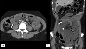 Isquemia mesentérica aguda secundaria a hernia interna. Tomografía computarizada (TC) abdominopélvica en plano axial (A) y reconstrucción MPR en plano coronal de TC abdominopélvica (B), ambas con contraste intravenoso yodado en fase portal. Asas de intestino delgado que presentan engrosamiento parietal y menor captación de contraste (flechas blancas), así como líquido libre (puntas de flecha negras) e ingurgitación de vasos mesentéricos, y aumento de la densidad o estriación de la grasa por edema (punta de flecha blanca). Se aprecian vasos mesentéricos en remolino (flechas negras), debido a la existencia de una hernia interna.