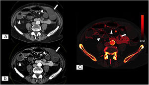 Isquemia mesentérica aguda secundaria a bridas. Tomografía computarizada (TC) dual abdominopélvica en plano axial con contraste intravenoso en fase portal (A), imagen monoenergética de bajo kilovoltaje (40KeV) en plano axial (B) y mapa de yodo en plano axial (C). Muestran una menor captación de contraste en las asas isquémicas (flechas blancas) en comparación con el resto de asas normoperfundidas (puntas de flecha blancas), sin engrosamiento parietal evidente. Respecto a la TC convencional, la imagen monoenergética de bajo kilovoltaje permite contrastar más los tejidos que captan yodo, lo que facilita la detección de áreas de tejido poco perfundidas. (Imagen cedida por Marta Calvo Imirizaldu e Isabel Vivas Pérez. Servicio de Radiología de la Clínica Universidad de Navarra).