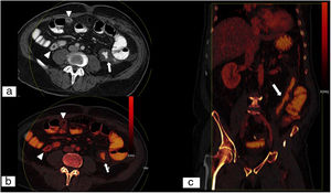 Colitis isquémica. Tomografía computarizada (TC) dual abdominopélvica con contraste intravenoso en fase portal y tras la ingesta de contraste oral. Imagen monoenergética obtenida con bajo kilovoltaje (70KeV) en plano axial (A), mapa de yodo en plano axial (B) y reconstrucción MPR en plano coronal de mapa de yodo (C). A pesar de la dificultad para valorar la pared intestinal tras la toma de contraste oral, se aprecia una menor captación de contraste en la pared engrosada del colon descendente (flecha blanca) en comparación con la pared normoperfundida de las asas localizadas en flanco derecho (puntas de flecha blanca), en relación con colitis isquémica. Las imágenes monoenergéticas virtuales de bajo kilovoltaje aumentan la diferencia en la atenuación entre los segmentos isquémicos y no isquémicos en comparación con la TC convencional. (Imagen cedida por Marta Calvo Imirizaldu e Isabel Vivas Pérez. Servicio de Radiología de la Clínica Universidad de Navarra).