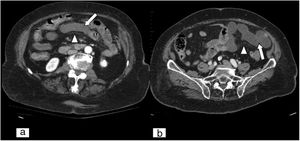 Alteración en el realce parietal intestinal. Tomografía computarizada abdominopélvica en plano axial con contraste intravenoso, en fase arterial (A) y en fase portal (B). Se observan asas de intestino delgado con disminución del realce parietal sugestivo de isquemia de origen arterial (flechas blancas) y leve estriación de la grasa por edema (puntas de flecha blancas).