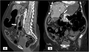 Neumatosis intestinal y gas venoso portomesentérico. Reconstrucción MPR en plano sagital (A) y reconstrucción MPR en plano coronal (B) de tomografía computarizada abdominopélvica con contraste intravenoso yodado en fase portal. Paciente de 85 años que acude por distensión abdominal, timpanismo, dolor abdominal difuso y clínica sospechosa de obstrucción intestinal de 24 horas de evolución. Gas en venas mesentérica superior y porta (flechas blancas) que se extiende a ramas portales intrahepáticas y se dispone periféricamente (puntas de flecha blancas), a diferencia de la presencia de gas en los radicales biliares (aerobilia). Ausencia de realce en la pared intestinal y neumatosis (flechas negras). Todo ello en contexto de proceso isquémico intestinal.