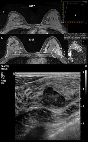Paciente BRCA1 de 32 años, en quien al año de la última resonancia magnética (RM) de cribado y antes del siguiente control de RM anual se palpa un nódulo nuevo en mama izquierda. A) RM mamaria con contraste intravenoso: secuencia axial 3D retardada con saturación grasa de 2017 (a) y de 2018/momento del diagnóstico (b), donde se aprecia en la RM de 2018 un nódulo nuevo en cuadrante superoexterno de mama izquierda, ovalado, lobulado, que ha lavado el contaste en relación con el tejido circundante en esa secuencia axial 3D retardada (círculo). En la mama contralateral (rectángulo) se aprecia un nódulo prepectoral circunscrito con realce interno homogéneo, ya conocido, con biopsia previa con resultado de fibroadenoma, estable. Curva de captación del nódulo de mama izquierda, tipo 3 (c) y mapa de difusión axial con valor ADC (coeficiente difusión aparente)=1,1×10-3 mm2/s del nódulo (d). El nódulo de la mama izquierda no era visible en la RM de 2017. B) Ecografía mamaria: nódulo sólido hipoecoico ovalado, lobulado, de márgenes no totalmente circunscritos de casi 3cm, subyacente a nódulo palpable de mama izquierda. Se realizó biopsia con aguja gruesa guiada por ecografía con resultado de «carcinoma ductal infiltrante grado III». Subtipo molecular triple negativo. Es el único caso de cáncer de intervalo que hemos tenido en nuestro centro hasta la fecha actual en paciente BRCA1.