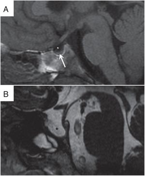 Hallazgos radiológicos en la silla turca. A) Silla turca parcialmente vacía, observada en secuencia T1 TSE sagital. Se observan las características típicas con la silla turca rellena casi completamente de líquido cefalorraquídeo (LCR) (*) y el adelgazamiento de la glándula hipofisaria (flecha). B) Silla turca vacía visualizada en secuencia T2 TSE sagital. Se identifica la silla turca remodelada y expandida completamente rellena por LCR (*) sin glándula hipofisaria visible.