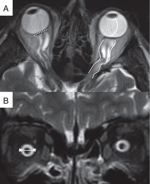 Hallazgos orbitarios. A) Imagen de resonancia magnética (RM), secuencia T2 FSE en el plano transversal, en la que se visualiza la distorsión de la morfología normal del globo ocular con aplanamiento de la esclera posterior bilateral (línea discontinua) así como la tortuosidad de los nervios ópticos en el plano horizontal (líneas continuas). B) Imagen de RM, secuencia STIR en el plano coronal, que demuestra la distensión de la vaina del nervio óptico tras el globo ocular (línea).