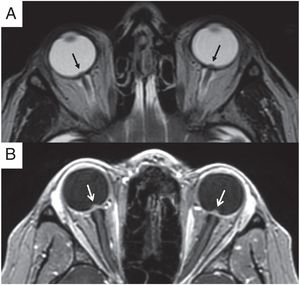 Hallazgos orbitarios asociados al papiledema. A) Imagen de resonancia magnética (RM), secuencia T2 FSE en el plano transversal. Se identifica la protrusión intraocular bilateral de la papila óptica (flechas negras). B) Mismo paciente que en la imagen A. La imagen de RM, secuencia T1 gradiente 3D transversal con saturación de la grasa tras administrar contraste intravenoso, demuestra el realce bilateral y simétrico en la región prelaminar de los nervios ópticos (flechas blancas).