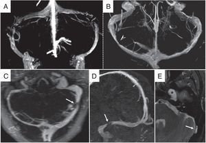 Estenosis de senos venosos transversos. Angio-RM venosa con contraste, reconstrucciones volumétricas 3D coronal (A) y transversal (B). A y B) Estenosis venosa extrínseca. A: estenosis bilateral típica en la región distal de los senos transversos. B: estenosis unilateral en el tercio medio del seno transverso derecho. C-E) Estenosis venosa intrínseca por granulación aracnoidea. C: angio-RM venosa con contraste con reconstrucción de máxima intensidad de proyección (MIP) en plano transversal en la que se visualiza hipoplasia del seno venoso transverso derecho y pequeño segmento estenótico significativo en tercio distal de seno transverso izquierdo. D: reconstrucción MIP en plano parasagital que demuestra los bordes bien delimitados de la estenosis (flecha blanca). E: secuencia STIR transversal en la que se identifica una granulación aracnoidea como causa de la estenosis (flecha blanca). Obsérvese también un meningocele del cavum de Meckel (asterisco) asociado a la HII.