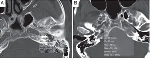 Aumento del área del foramen oval. A) Área del foramen oval en tomografía computarizada de cabeza sin contraste en paciente sano, con valor de 26,4 mm2. Compárese con un paciente con hipertensión intracraneal idiopática (B) en el que el área media del foramen oval es de 41,9 mm2, mayor de 40 mm2.