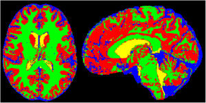 Incremento del volumen de líquido cefalorraquídeo (LCR) extraventricular normalizado. Ejemplo de segmentación semiautomática de LCR extraventricular intracraneal en el que se demuestra la diferenciación del LCR intraventricular (en amarillo) del LCR extraventricular (azul). Sustancia gris y sustancia blanca segmentadas y diferenciadas en otros colores (rojo y verde, respectivamente).