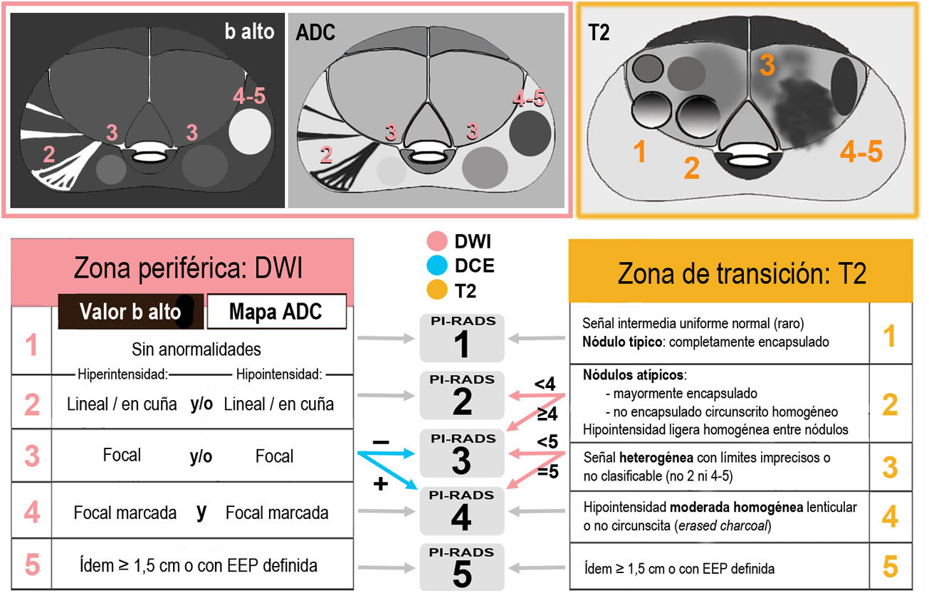 Resonancia magnética de próstata: guía práctica de interpretación e ...