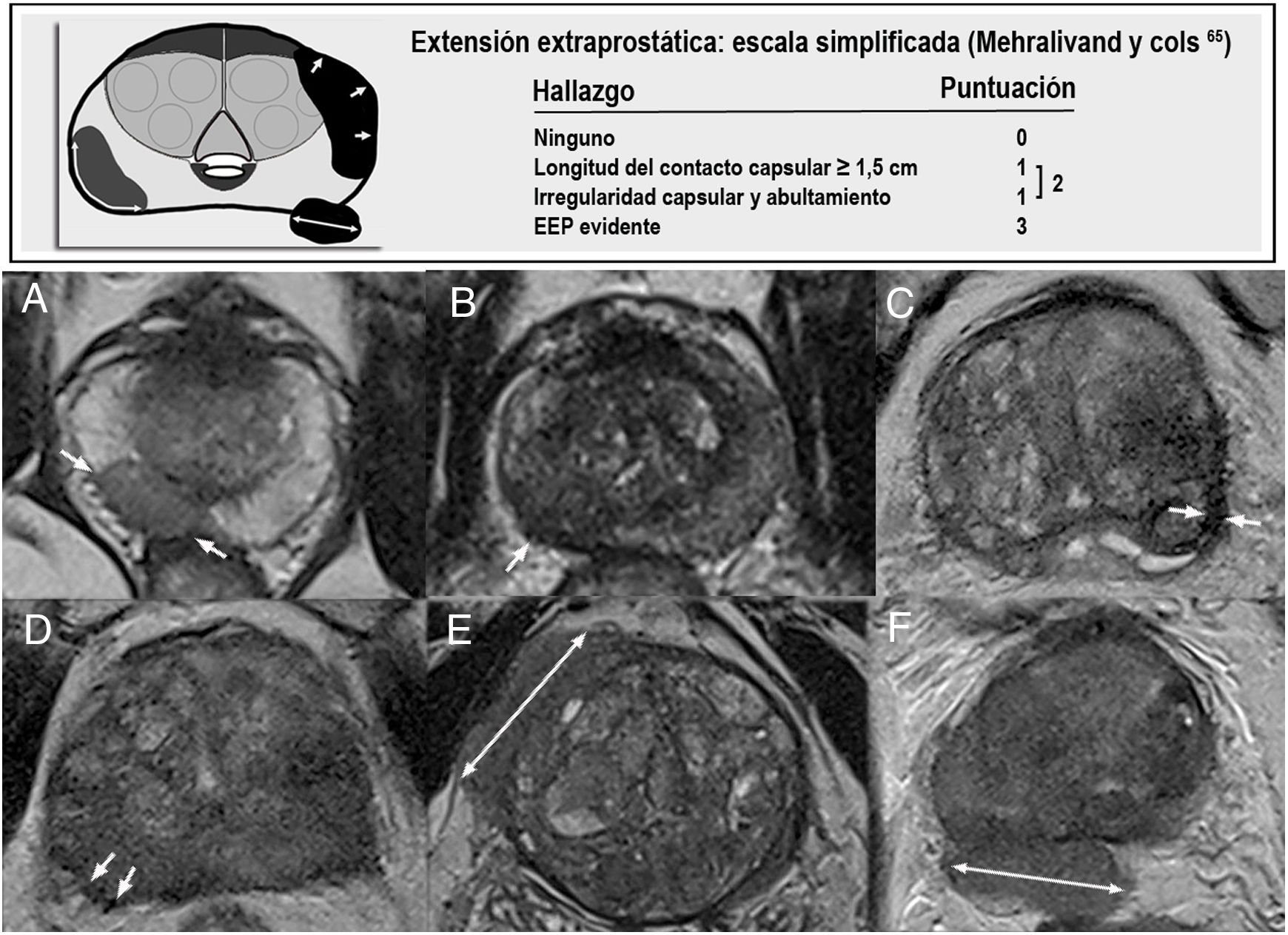 Resonancia magnética de próstata: guía práctica de interpretación e ...