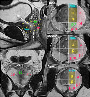 Anatomía sectorial de la próstata según PI-RADSv2.1. El esquema sectorial (ZP en rosa, ZT en naranja, ZC en verde y EFMA en azul) es idéntico en los tres niveles excepto los dos pequeños sectores adicionales de la ZC en el basal. Por delante de la uretra prostática (UP) se encuentra el EFMA y por detrás de ella, la ZC en la mitad superior y la ZP medioapical en la parte inferior. La ZC normal es simétrica en forma de V en planos coronales. EFMA: estroma fibromuscular anterior; ZC: zona central; ZP: zona periférica; ZT: zona transicional.
