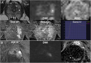 Valor del estudio dinámico con contraste (DCE). A) PI-RADS 3 en difusión en la zona periférica que se eleva a 4 tras el DCE: restricción focal poco marcada al menos en uno de los tipos de imágenes de difusión (ligera hiperintensidad en DWI b alto, inapreciable en ADC), con DCE positivo: realce focal temprano que corresponde al hallazgo sospechoso. B) Secuencia dominante inadecuada: mapa ADC no valorable por artefactos con origen en prótesis de cadera derecha. Hiperintensidad focal en DWI con DCE positivo: PI-RADS 4.