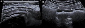 a) Imagen ecográfica del colon descendente que presenta un engrosamiento simétrico de la pared, con conservación de las capas (entre cursores) y afectación de un tramo largo, relacionado con colitis isquémica. b) Imagen ecográfica que muestra un tramo corto de la pared de sigma con engrosamiento asimétrico e hipoecoico (flechas gruesas) por adenocarcinoma, con pérdida de la estructura de las capas. L: luz.