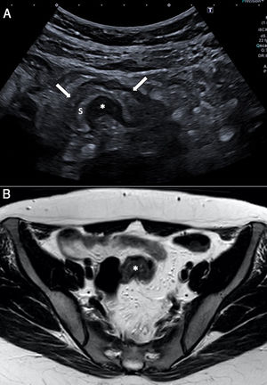Mujer de 27 años con dolor hipogástrico que no mejora con analgesia habitual. A) La ecografía abdominal muestra un nódulo hipoecoico (*) unido a la pared del colon sigmoide que penetra en la muscular propia con crecimiento hacia la submucosa (S), condicionando colapso de la luz (flechas). B) El estudio mediante resonancia magnética pélvica (imagen transversal TSE, potenciada en T2) confirma una lesión de morfología nodular (*) en la pared del sigma, con crecimiento hacia la submucosa y con focos hiperintensos en su interior que sugieren tejido glandular. La paciente requirió intervención quirúrgica y el estudio anatomopatológico confirmó la endometriosis intestinal.
