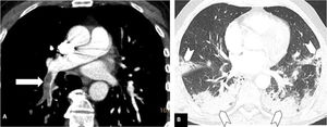 Tromboembolismo pulmonar en localización media en un paciente con afectación parenquimatosa moderada por COVID-19. Angio-TC de tórax. A) Defecto de repleción en la arteria lobar inferior derecha (flecha blanca). B) Afectación parenquimatosa con consolidaciones periféricas en la región posterior de ambos lóbulos inferiores, del lóbulo medio y de la língula (cabezas de flecha), que afecta entre el 30-60% del parénquima pulmonar.