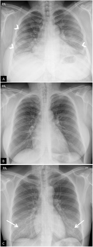 Falsos positivos o pitfalls. A y B) Radiografía de tórax poco inspirada. Mujer de 38 años con clínica sospechosa de enfermedad COVID-19. A) Radiografía de tórax posteroanterior. Aumento de la densidad bilateral, de predominio en campos medios e inferiores, sospechoso de neumonía por COVID-19 (puntas de flecha). Escasa inspiración (se identifican 7 arcos costales posteriores) y mamas voluminosas. B) Misma paciente. Repetición de radiografía de tórax a los pocos minutos tras inspiración forzada, donde se objetiva desaparición de todos los hallazgos descritos previamente (obsérvese el cambio en la morfología de la silueta cardíaca). C) Artefacto por aumento de densidad mamaria. Mujer de 18 años con clínica sospechosa de enfermedad COVID-19. Opacidades bilaterales y simétricas en campos inferiores producidas por la alta densidad del tejido mamario (flechas). PCR negativa para SARS-CoV-2.