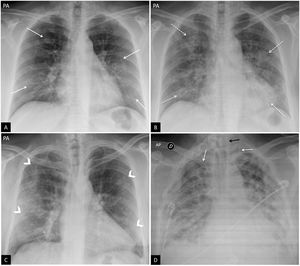 Hallazgos típicos de la neumonía COVID-19. A) Mujer de 47 años con sospecha clínica de enfermedad COVID-19. Radiografía de tórax posteroanterior (PA). Patrón intersticial-reticular de predominio periférico (flechas). B) Misma paciente que en imagen A. Radiografía de tórax PA realizada 3 días después. PCR positiva para SARS-CoV-2. Aunque la radiografía está menos inspirada, se objetiva la aparición de tenues opacidades alveolares (flechas punteadas) redondeadas bilaterales y periféricas. C) Varón de 57 años con disnea y PCR positiva para SARS-CoV-2. Opacidades periféricas bilaterales en campos superiores, medios e inferiores (puntas de flecha). D) Varón de 45 años con disnea y COVID-19 confirmada con PCR. Radiografía de tórax anteroposterior con múltiples áreas de consolidación confluentes difusas bilaterales que afectan extensamente a ambos pulmones. Nótese la presencia de dos vías venosas centrales, una yugular izquierda y otra subclavia derecha (flechas blancas) y de sonda digestiva (flecha negra).