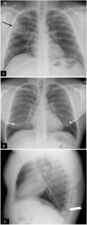 Hallazgos atípicos de neumonía COVID-19. A) Neumonía lobar. Varón de 28 años con clínica compatible con enfermedad COVID-19 y PCR positiva para SARS-CoV-2. Radiografía de tórax en proyección posteroanterior (PA). Afectación del lóbulo superior derecho (flecha). B y C) Afectación bilateral y derrame pleural. Varón de 17 años con fiebre y PCR positiva para SARS-CoV-2. Radiografía de tórax PA (B) y lateral (C). Tenues infiltrados bilaterales en campos inferiores (flechas) con mínimo derrame pleural en el seno costodiafragmático posterior izquierdo (punta de flecha).