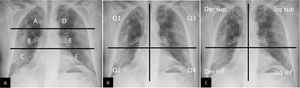 Métodos de graduación de la gravedad de la afectación pulmonar secundaria a COVID-19 mediante radiografía de tórax. A) Método de graduación sugerido por Borghesi et al.34,35. Mediante una línea horizontal superior (borde inferior del cayado aórtico) y otra línea horizontal inferior (borde inferior de vena pulmonar inferior derecha) se obtienen 6 campos pulmonares. A cada uno se le asigna una puntuación en función de los hallazgos radiológicos: 0 si no existen hallazgos, 1 si existen infiltrados intersticiales, 2 si existen infiltrados intersticiales y alveolares con predominio intersticial, y 3 si existen infiltrados intersticiales y alveolares con predominio alveolar. La puntuación máxima es de 18. Siguiendo esta graduación, en este caso presentado la puntuación sería de: A=2, B=3, C=3, D=3, E=3 y F=3. Puntuación total = 17/18. B) Adaptación del método RALE propuesto por Warren et al.36, ideado inicialmente para graduar la gravedad del edema agudo de pulmón. Mediante una línea vertical (sobre la columna vertebral) y una horizontal (borde inferior de bronquio principal izquierdo) se obtienen 4 cuadrantes. A cada cuadrante se le asigna una puntuación de 0 a 4 dependiendo de la extensión de la consolidación o del vidrio deslustrado (0=sin hallazgos; 1<25%; 2=25-50%; 3=50-75%; 4>75%), que debe multiplicarse por otra puntuación asignada a la densidad de la consolidación (1 =incipiente, 2 = moderada, 3 = densa). La puntuación máxima es de 48. Siguiendo este método de graduación, en el ejemplo presentado obtendríamos: Q1 = 2×1 = 2; Q2 = 4×3 = 12; Q3 = 2×3 = 6, y Q4 = 2×3 = 6. Puntuación total = 26/48. C) Método de graduación utilizado por Schalekamp et al.79. Divide el tórax en 4 cuadrantes. A cada cuadrante le asigna una puntuación de 0 a 2. 0 = no afectación; 1 = afectación media/moderada (0-50% del parénquima pulmonar); 2 = afectación grave (> 50% del parénquima). Puntuación máxima de 8. En este ejemplo obtendríamos: cuadrante derecho superior = 1; cuadrante derecho inferior = 2; cuadrante izquierdo superior = 1; cuadrante izquierdo inferior = 1. Puntuación total = 5/8. Este estudio encontró que puntuaciones con una media de 4,4±1,9 y una afectación bilateral estaban asociadas con enfermedad crítica.