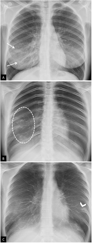 Tomosíntesis. Mujer de 30 años con COVID-19. A) Proyección posteroanterior de tórax convencional. Opacidades bilaterales en campos inferiores (flechas) que podrían corresponder a tejido mamario denso. Existen dudas en hemitórax derecho (flechas), por lo que se decide realizar estudio de tomosíntesis digital (TD). B y C) Imágenes de TD. Se observa consolidación extensa en el campo pulmonar inferior derecho (círculo blanco en B), así como pequeñas consolidaciones contralaterales solo evidenciadas mediante TD (punta de flecha en C) correspondientes a focos de neumonía. Reproducido por cortesía de la Dra. J. Plasencia del Hospital Universitario Morales Meseguer de Murcia.
