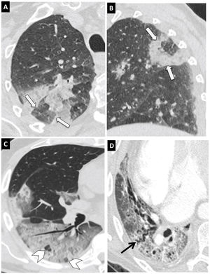 Hallazgos típicos de neumonía COVID-19 en tomografía computarizada (TC). Imágenes de TC de tórax con cortes de 1mm. A y B) Imágenes axial (A) y sagital (B) que muestran una lesión en el segmento posterior del lóbulo superior derecho con el signo del halo invertido (flechas). C) Extensa afectación en vidrio deslustrado con áreas de consolidación en lóbulo inferior derecho con el signo de la vacuola (puntas de flecha). D) Alteración de la arquitectura del lóbulo inferior derecho con patrón en empedrado y dilatación bronquial (flecha negra).
