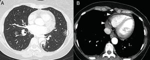 Mujer de 50 años con clínica febril y dolor retroesternal con roce pericárdico en auscultación. En la tomografía computarizada se aprecian opacidades “en vidrio deslustrado” (A) en relación con afectación leve por COVID-19 (círculos) y derrame pericárdico leve (puntas de flecha en B).