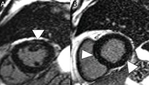 Varón de 59 años, sin ningún antecedente personal de interés, con neumonía leve por COVID-19. Presenta dolor torácico y elevación de troponinas seriadas, con sospecha de acinesia inferior en ecocardiografía. En reconstrucciones en eje corto y secuencia de realce tardío se identifican imágenes lineales hiperintensas en el espesor del miocardio (puntas de flecha en A y B) compatible con miocarditis.
